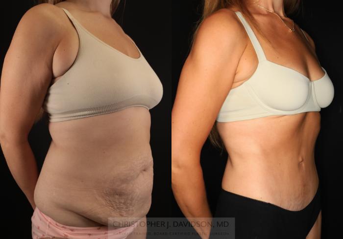 Tummy Tuck (Abdominoplasty) Case 494 Before & After Right Oblique | Boston, MA | Christopher J. Davidson, MD