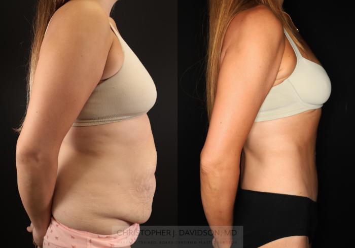 Tummy Tuck (Abdominoplasty) Case 494 Before & After Right Side | Boston, MA | Christopher J. Davidson, MD