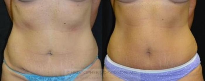 Tummy Tuck (Abdominoplasty) Case 56 Before & After View #1 | Boston, MA | Christopher J. Davidson, MD
