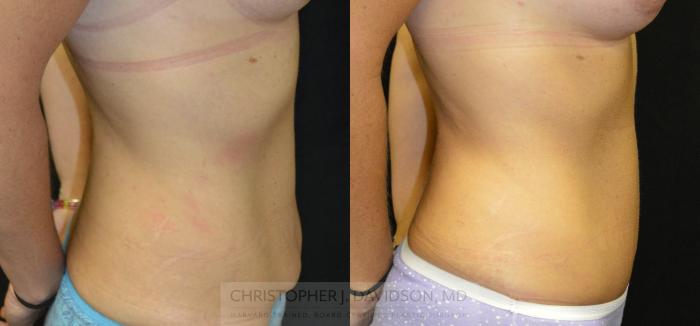 Tummy Tuck (Abdominoplasty) Case 56 Before & After View #2 | Boston, MA | Christopher J. Davidson, MD