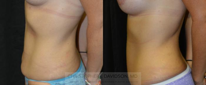 Tummy Tuck (Abdominoplasty) Case 56 Before & After View #3 | Boston, MA | Christopher J. Davidson, MD