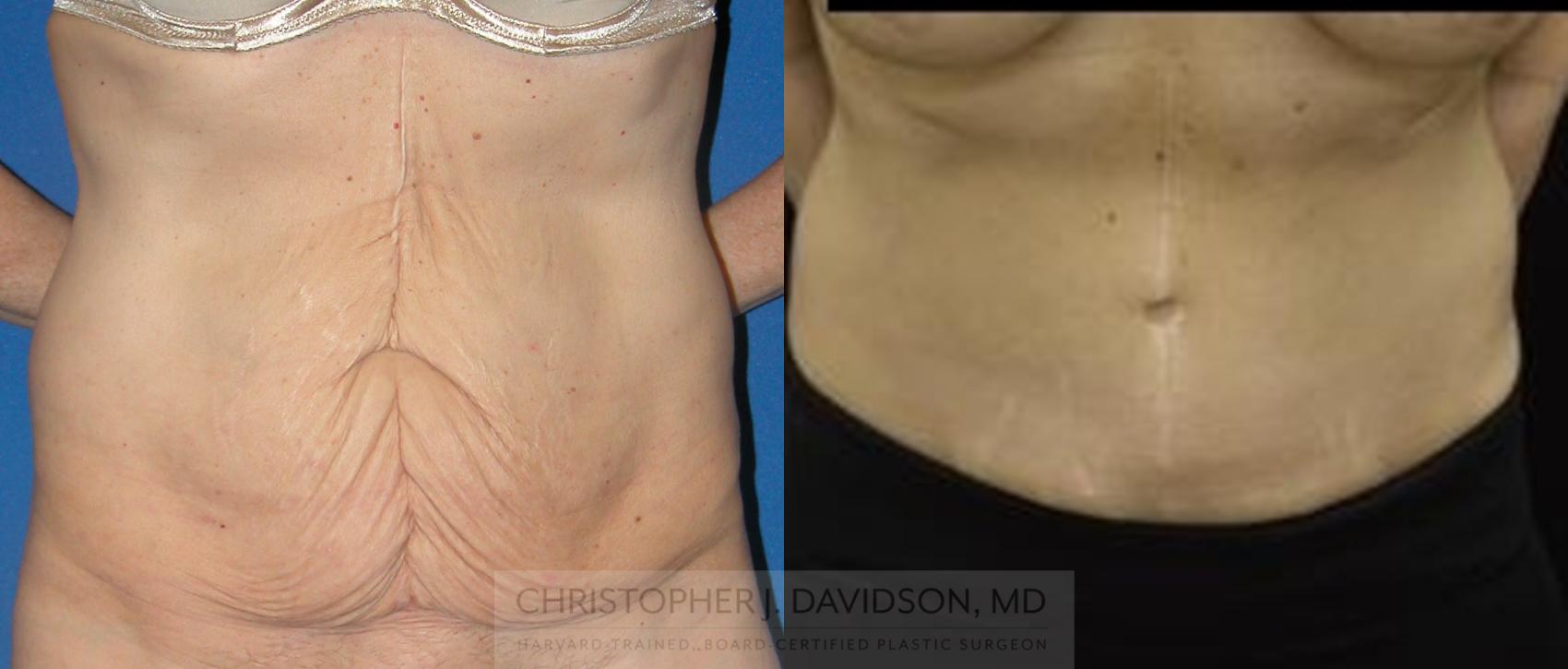 Tummy Tuck (Abdominoplasty) Case 67 Before & After View #1 | Boston, MA | Christopher J. Davidson, MD