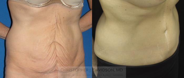 Tummy Tuck (Abdominoplasty) Case 67 Before & After View #2 | Boston, MA | Christopher J. Davidson, MD