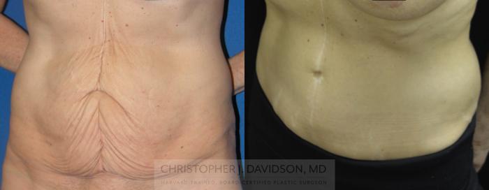 Tummy Tuck (Abdominoplasty) Case 67 Before & After View #3 | Boston, MA | Christopher J. Davidson, MD