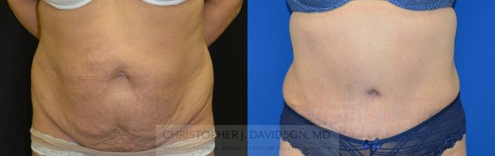 Tummy Tuck (Abdominoplasty) Case 73 Before & After View #1 | Boston, MA | Christopher J. Davidson, MD