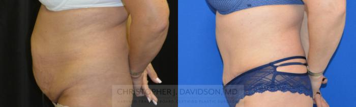 Tummy Tuck (Abdominoplasty) Case 73 Before & After View #2 | Boston, MA | Christopher J. Davidson, MD