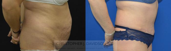Tummy Tuck (Abdominoplasty) Case 73 Before & After View #3 | Boston, MA | Christopher J. Davidson, MD