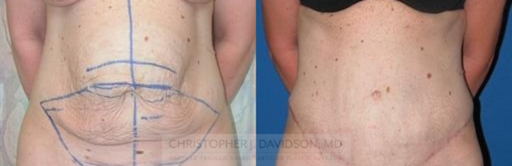 Tummy Tuck (Abdominoplasty) Case 80 Before & After View #1 | Wellesley, MA | Christopher J. Davidson, MD