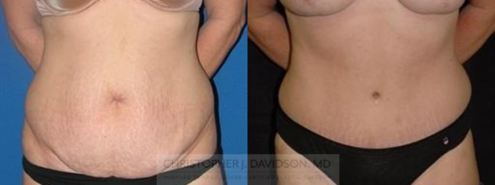 Tummy Tuck (Abdominoplasty) Case 83 Before & After View #1 | Wellesley, MA | Christopher J. Davidson, MD