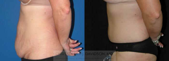 Tummy Tuck (Abdominoplasty) Case 83 Before & After View #2 | Boston, MA | Christopher J. Davidson, MD
