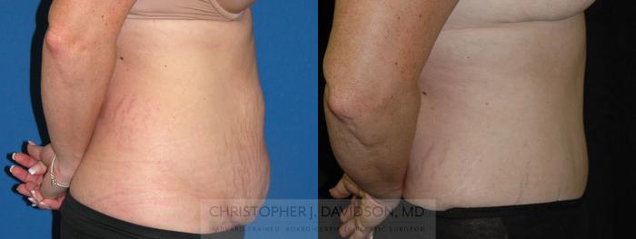 Tummy Tuck (Abdominoplasty) Case 83 Before & After View #3 | Boston, MA | Christopher J. Davidson, MD