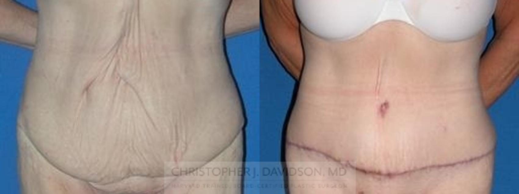 Tummy Tuck (Abdominoplasty) Case 89 Before & After View #1 | Wellesley, MA | Christopher J. Davidson, MD