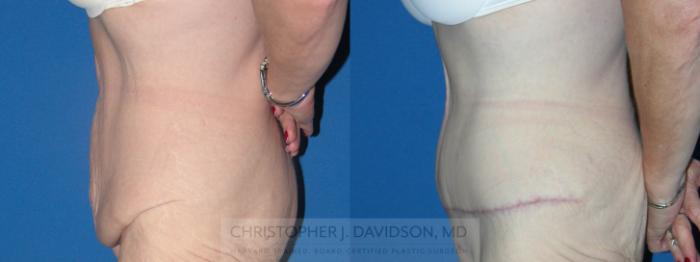 Tummy Tuck (Abdominoplasty) Case 89 Before & After View #2 | Boston, MA | Christopher J. Davidson, MD