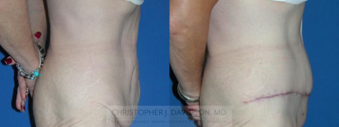 Tummy Tuck (Abdominoplasty) Case 89 Before & After View #3 | Boston, MA | Christopher J. Davidson, MD