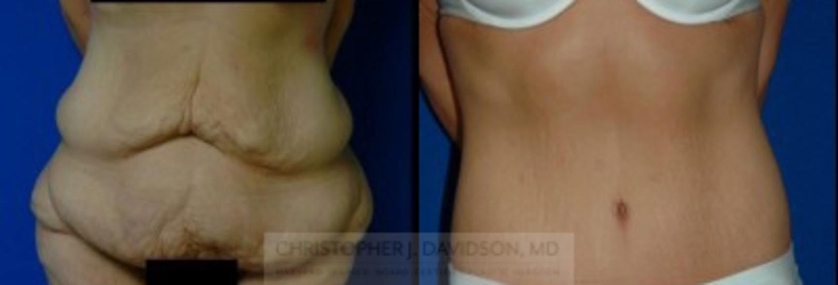 Tummy Tuck (Abdominoplasty) Case 9 Before & After View #1 | Wellesley, MA | Christopher J. Davidson, MD