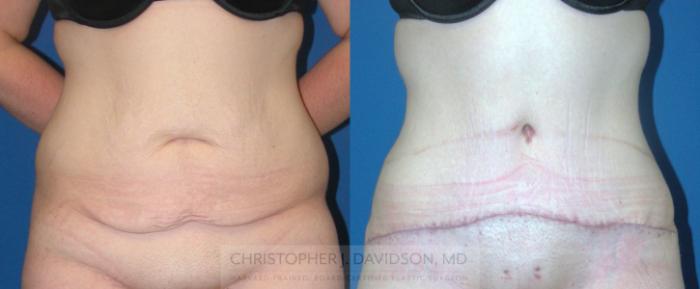 Tummy Tuck (Abdominoplasty) Case 94 Before & After View #1 | Boston, MA | Christopher J. Davidson, MD