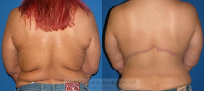 Upper Body Lift Case 105 Before & After View #1 | Boston, MA | Christopher J. Davidson, MD