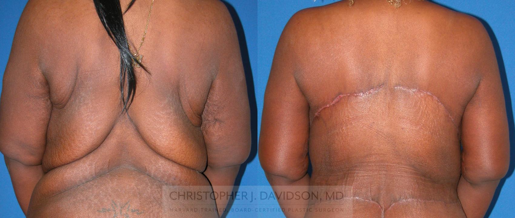 Upper Body Lift Case 219 Before & After View #1 | Wellesley, MA | Christopher J. Davidson, MD