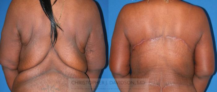 Upper Body Lift Case 219 Before & After View #1 | Boston, MA | Christopher J. Davidson, MD