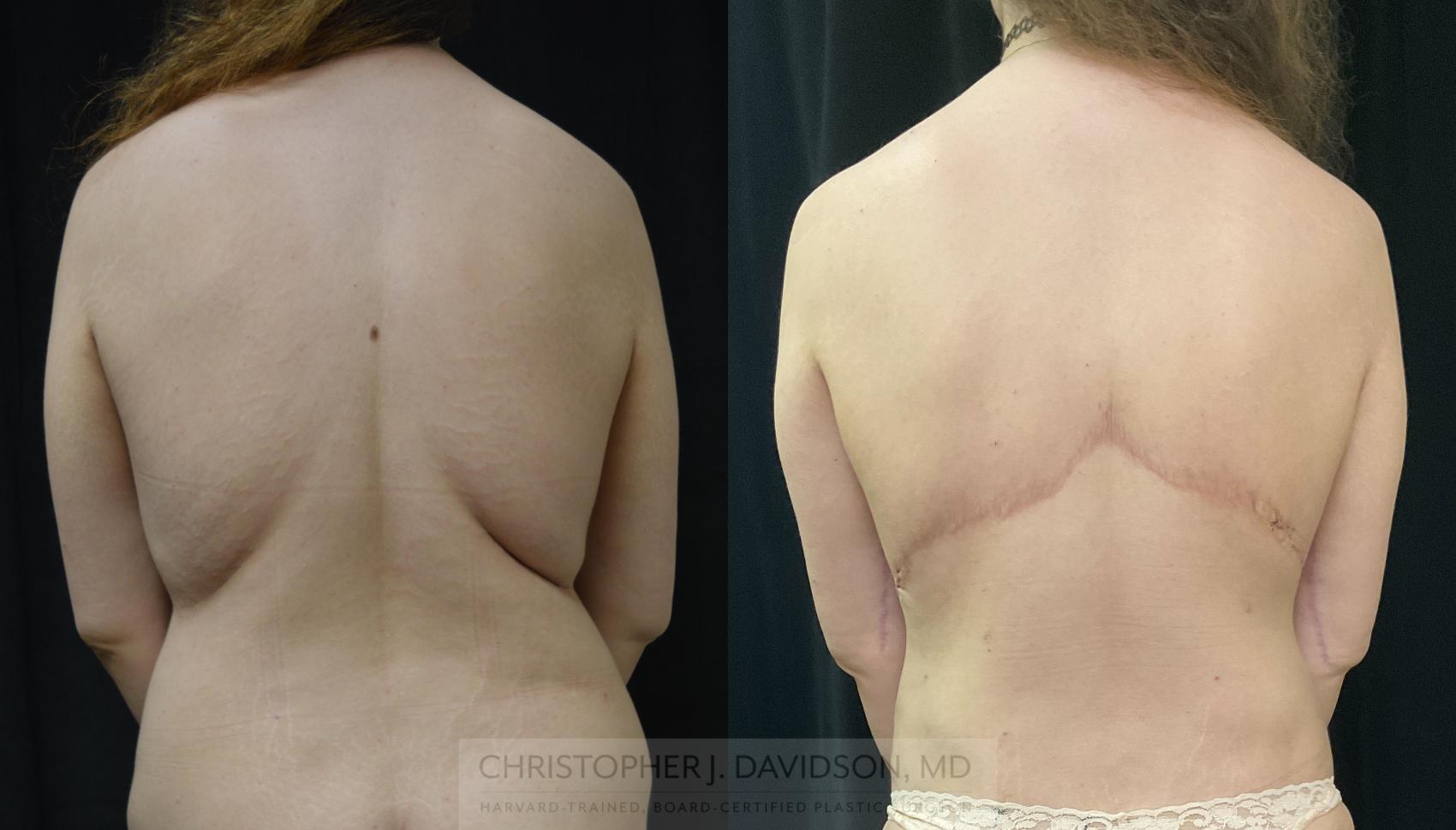 Upper Body Lift Case 430 Before & After Back | Boston, MA | Christopher J. Davidson, MD