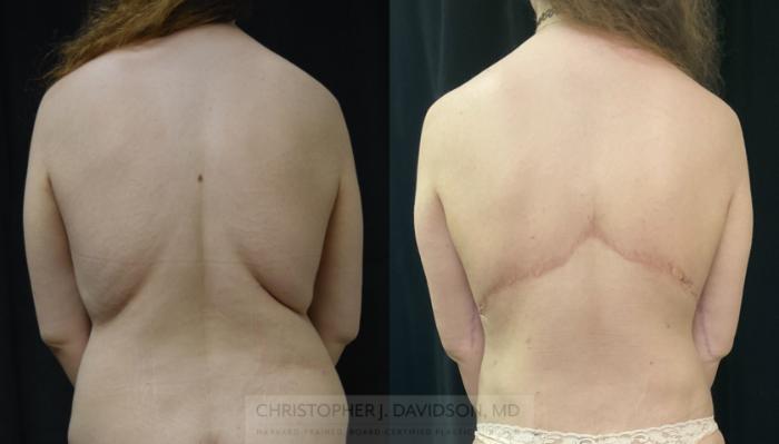 Upper Body Lift Case 430 Before & After Back | Boston, MA | Christopher J. Davidson, MD